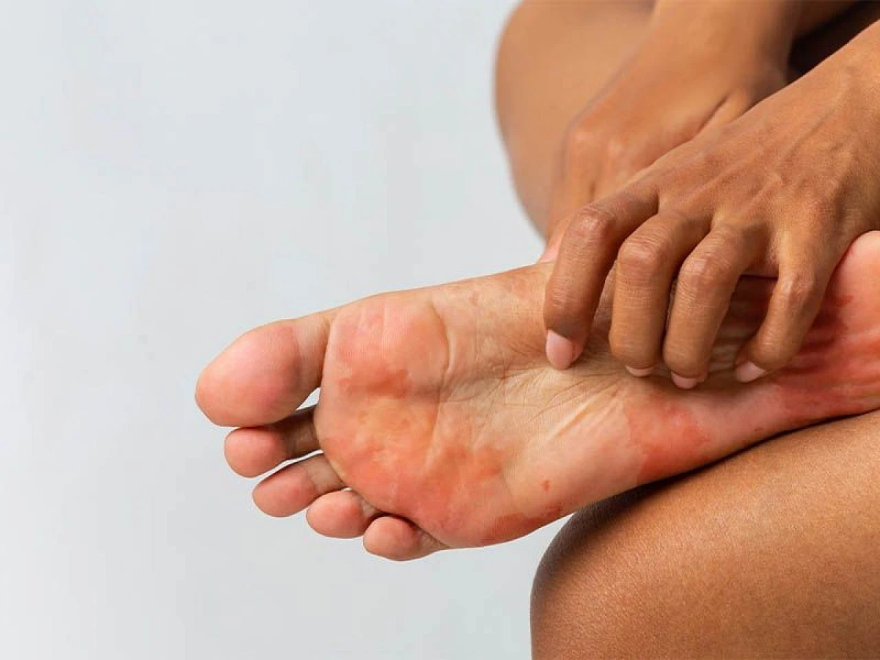 Ayaktaki nasıl geçer? Evde ayak nasırına ne iyi gelir? - 3. Resim