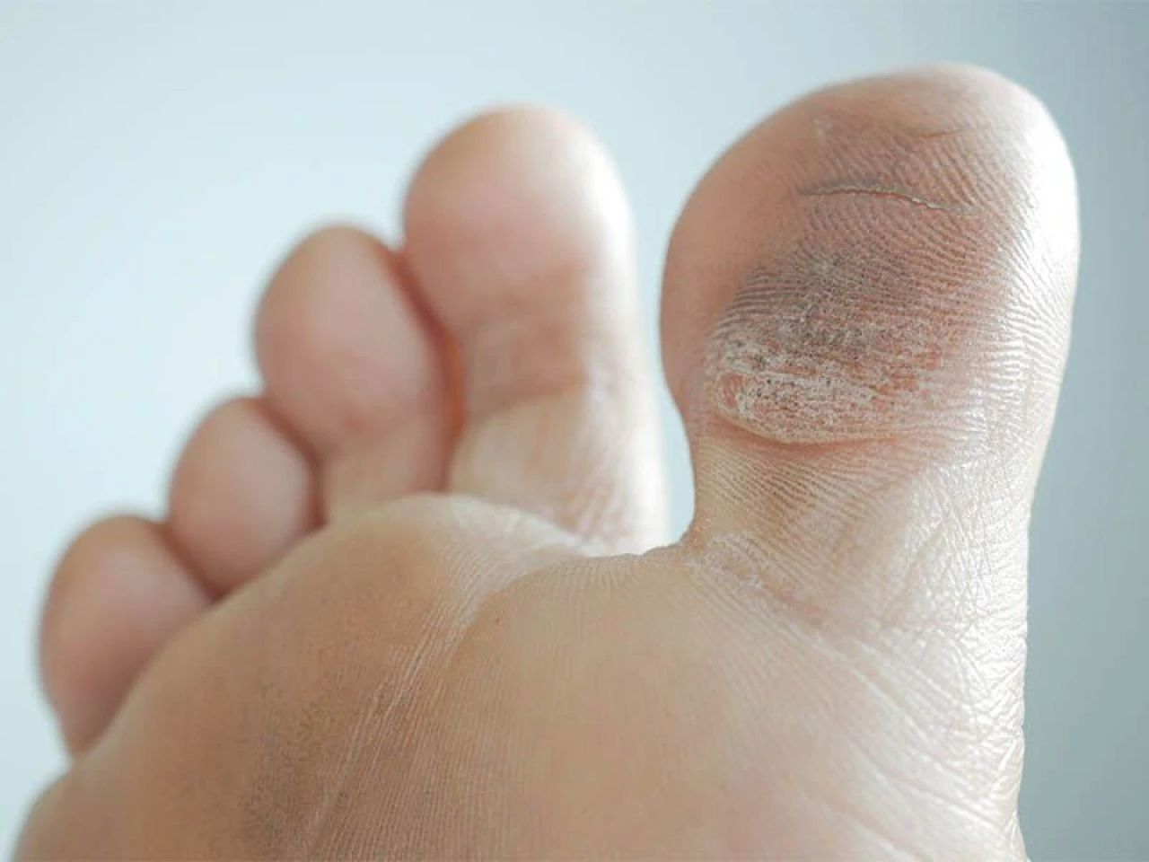 Ayaktaki nasıl geçer? Evde ayak nasırına ne iyi gelir? - 2. Resim