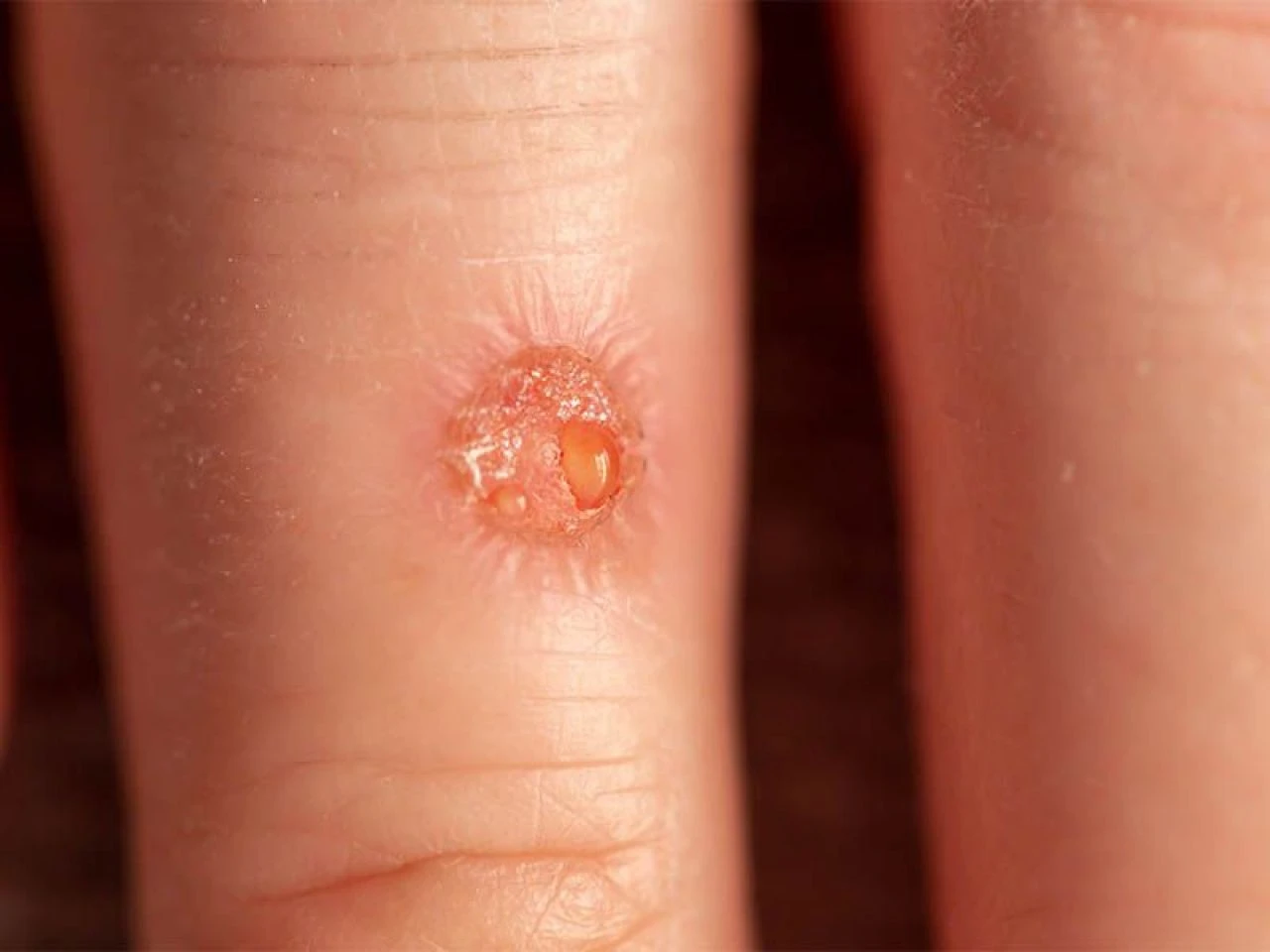 Eldeki siğil neden olur ve nasıl geçer? Ellerdeki siğile ne iyi gelir? - 4. Resim