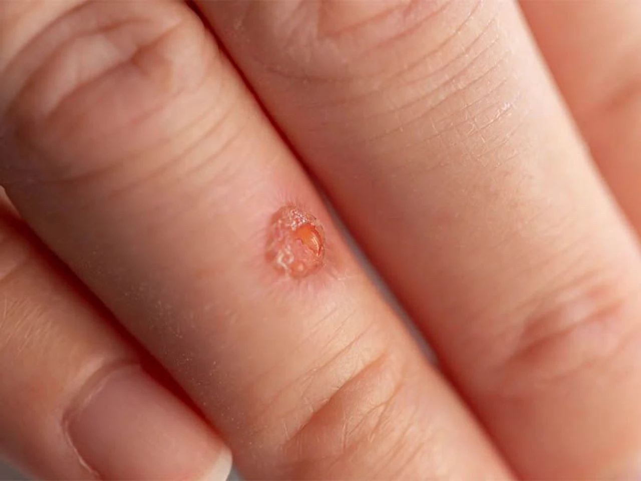 Eldeki siğil neden olur ve nasıl geçer? Ellerdeki siğile ne iyi gelir? - 2. Resim