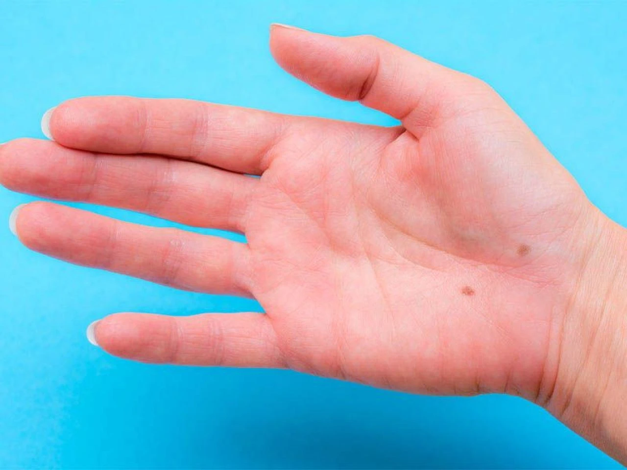 Eldeki siğil neden olur ve nasıl geçer? Ellerdeki siğile ne iyi gelir? - 3. Resim