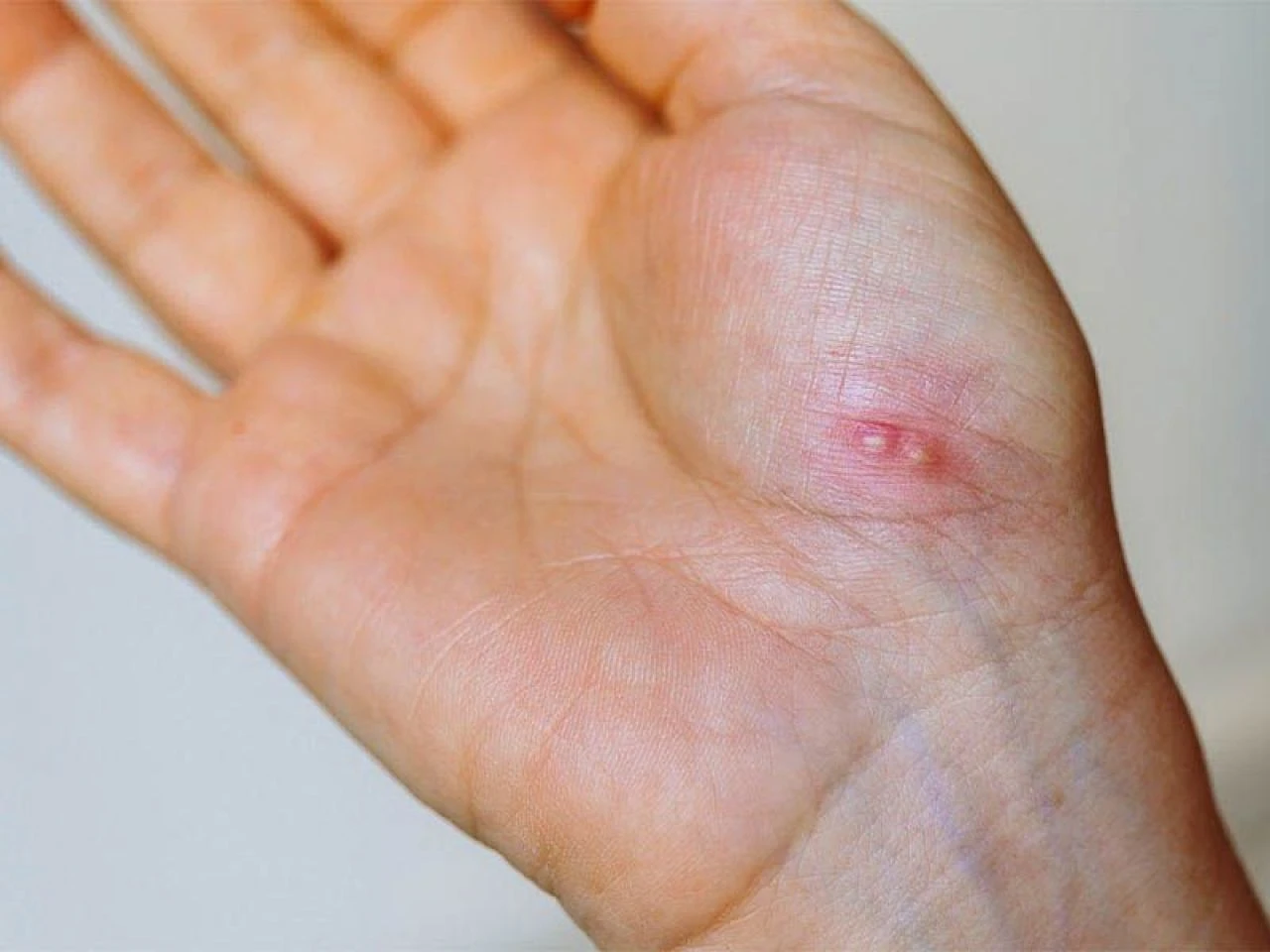 Eldeki siğil neden olur ve nasıl geçer? Ellerdeki siğile ne iyi gelir? - 1. Resim
