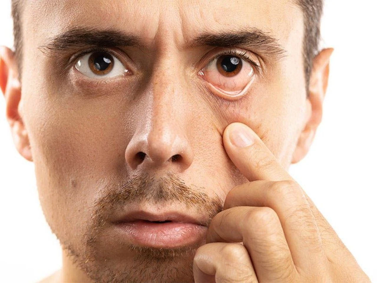 Göz altı yağ bezeleri neden olur ve nasıl geçer? Göz altındaki yağ bezesine ne iyi gelir?