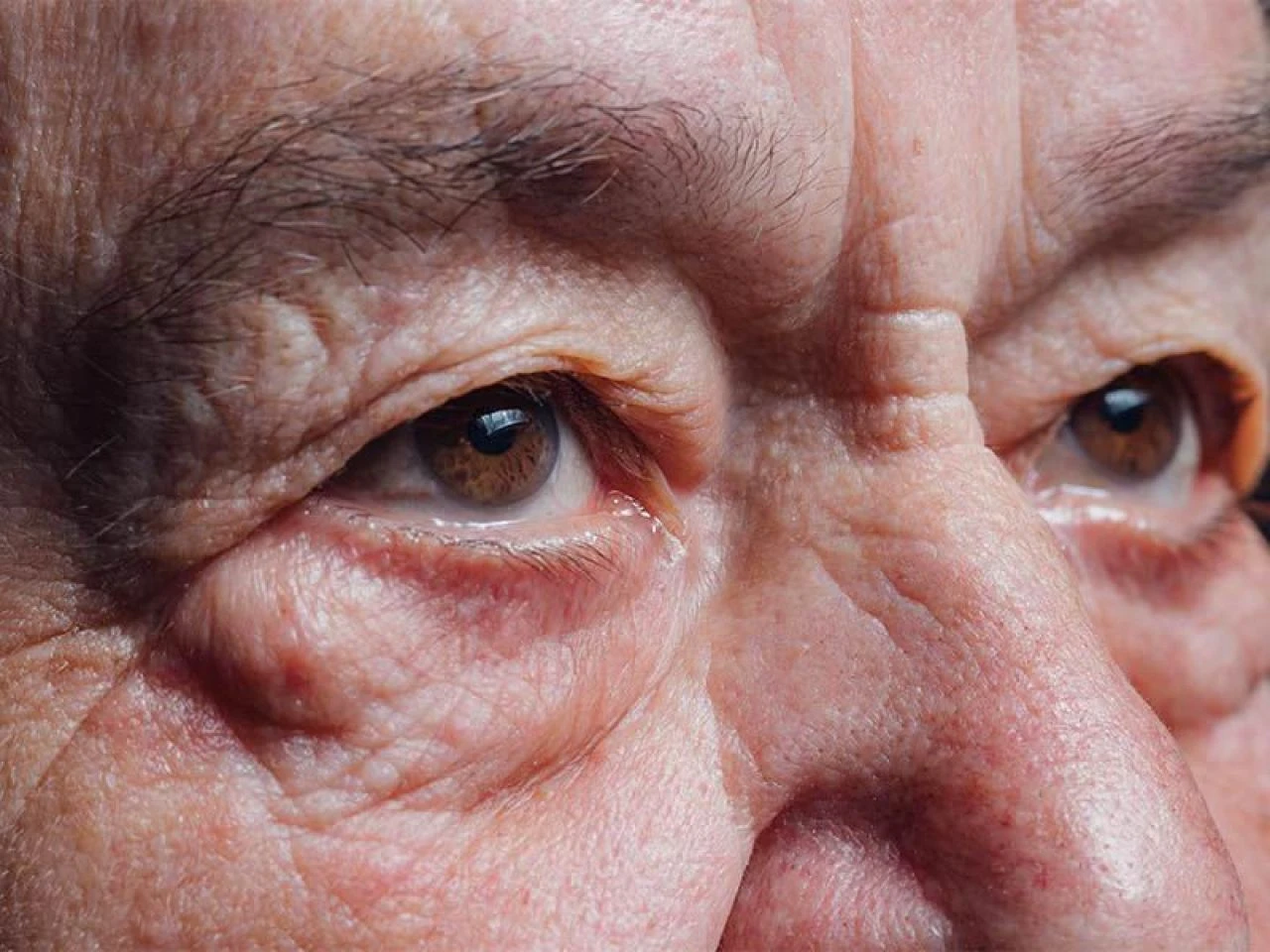 Göz altı yağ bezeleri neden olur ve nasıl geçer? Göz altındaki yağ bezesine ne iyi gelir?