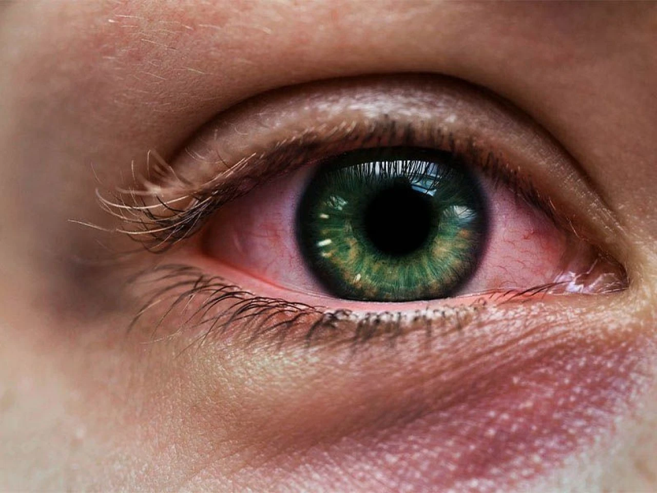 Göz kızarıklığı neden olur ve nasıl geçer? Gözlerde olan kızarıklığa ne iyi gelir?