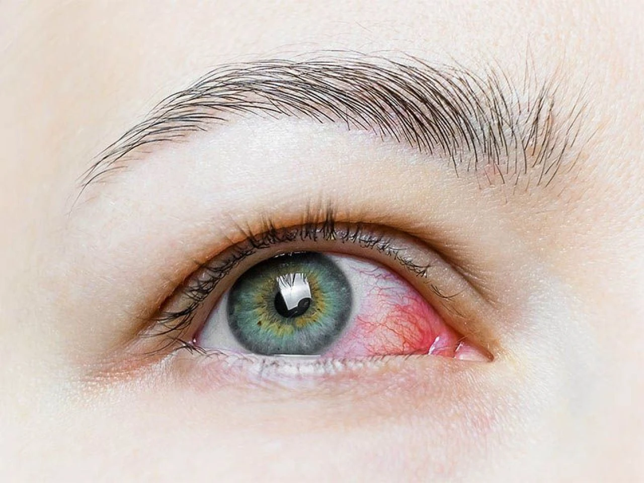 Göz kızarıklığı neden olur ve nasıl geçer? Gözlerde olan kızarıklığa ne iyi gelir?