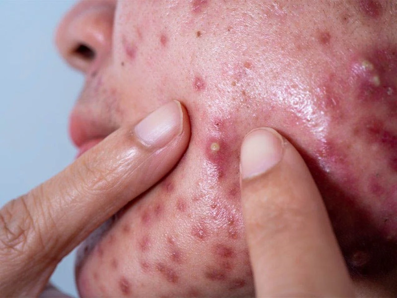 İltihaplı sivilce neden olur ve en hızlı nasıl geçer? İltihaplı sivilceye ne iyi gelir?