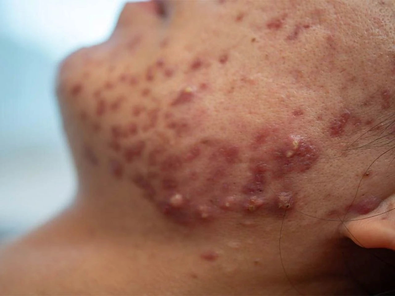 İltihaplı sivilce neden olur ve en hızlı nasıl geçer? İltihaplı sivilceye ne iyi gelir?