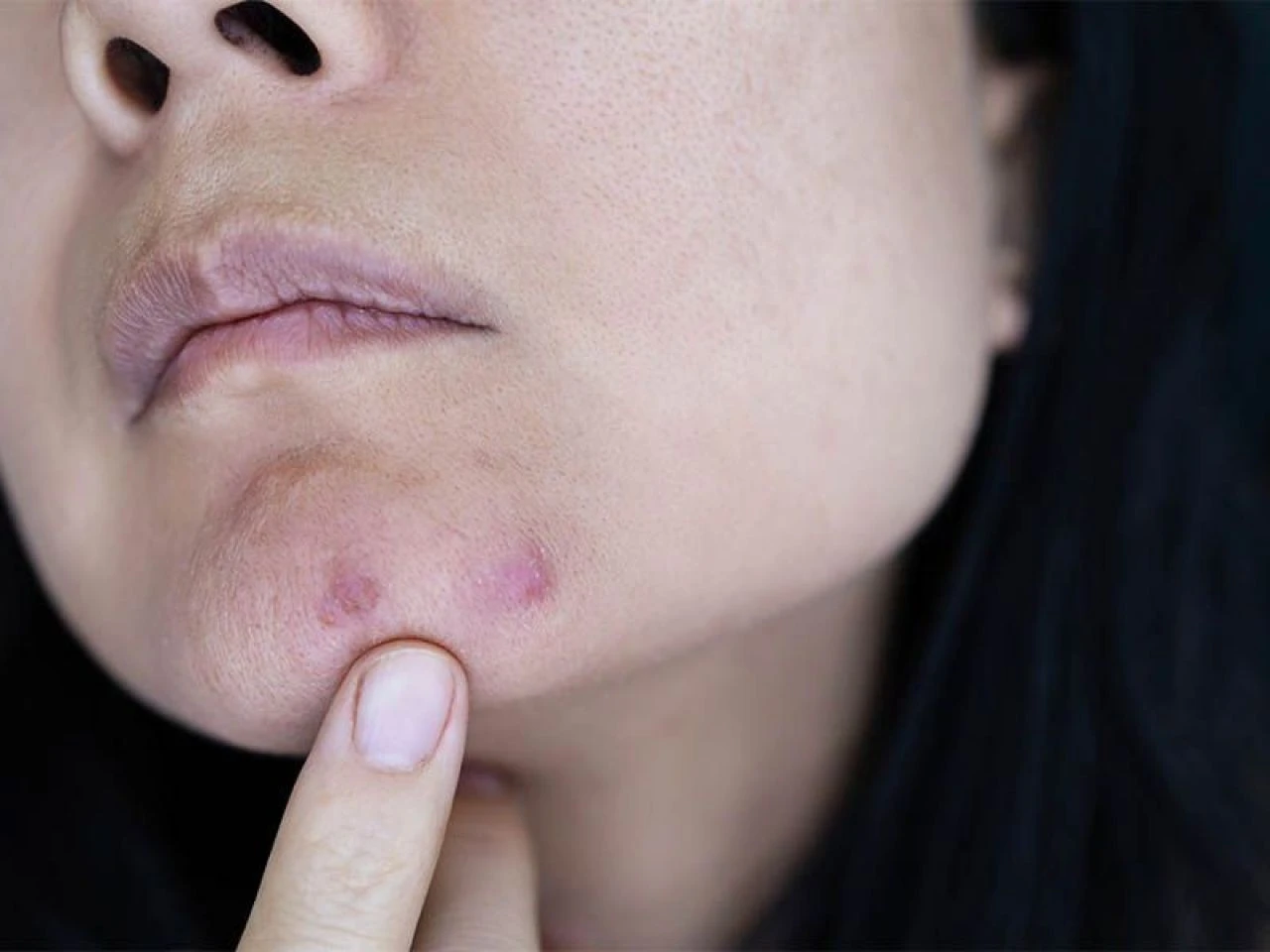 İltihaplı sivilce neden olur ve en hızlı nasıl geçer? İltihaplı sivilceye ne iyi gelir?