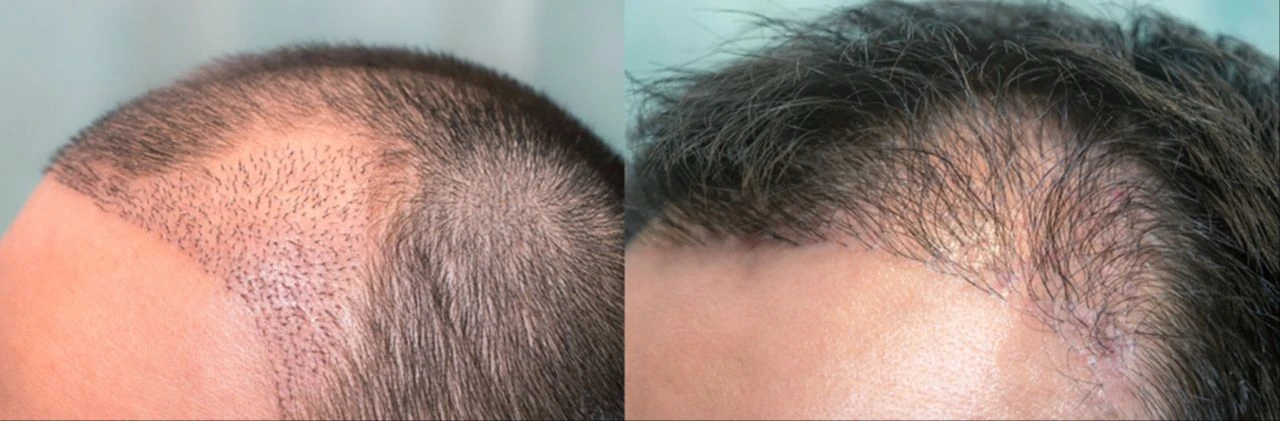 Saç ektirmek, yeni yöntem sonrası tarih oluyor! Doğal saç çıkarmayı etkileyen 'anahtar' keşfedildi