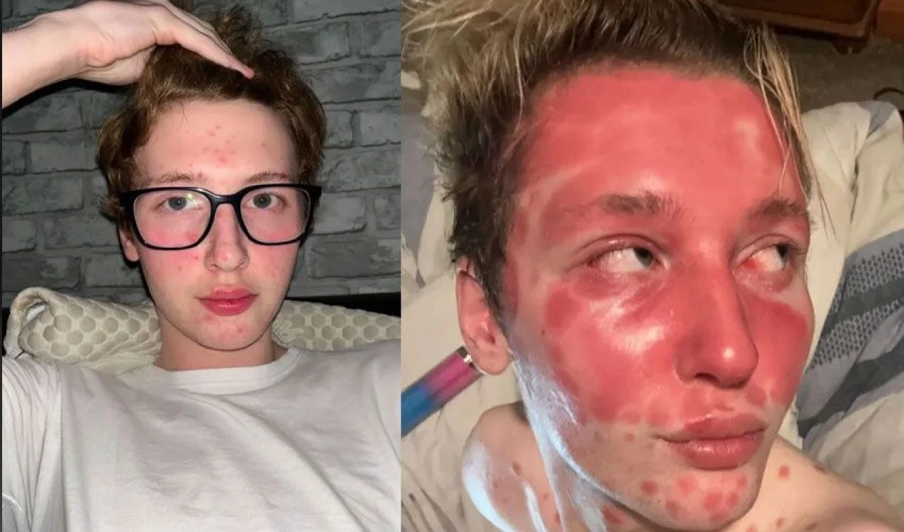 Genç fenomeni dolgu mahvetti! Lekeler önce yüzünü ardından vücudunu kapladı - 2. Resim