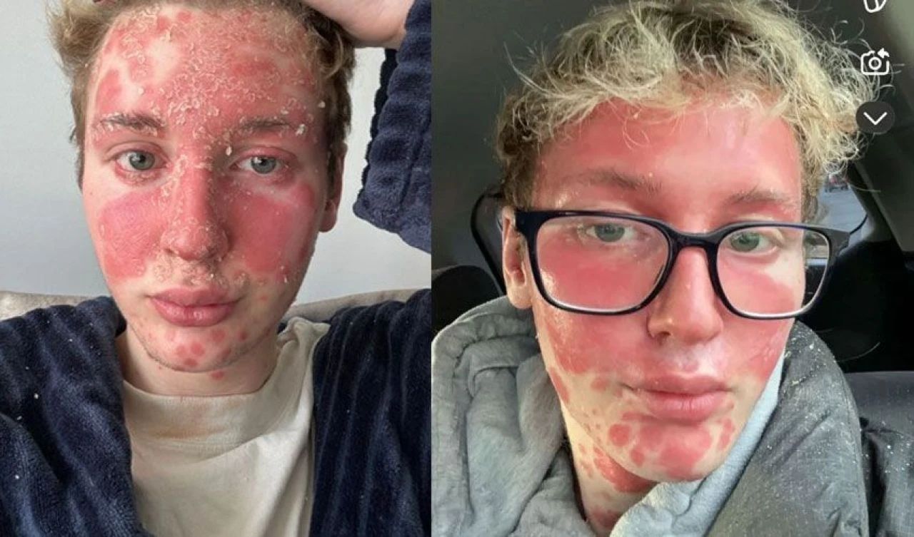 Genç fenomeni dolgu mahvetti! Lekeler önce yüzünü ardından vücudunu kapladı - 4. Resim