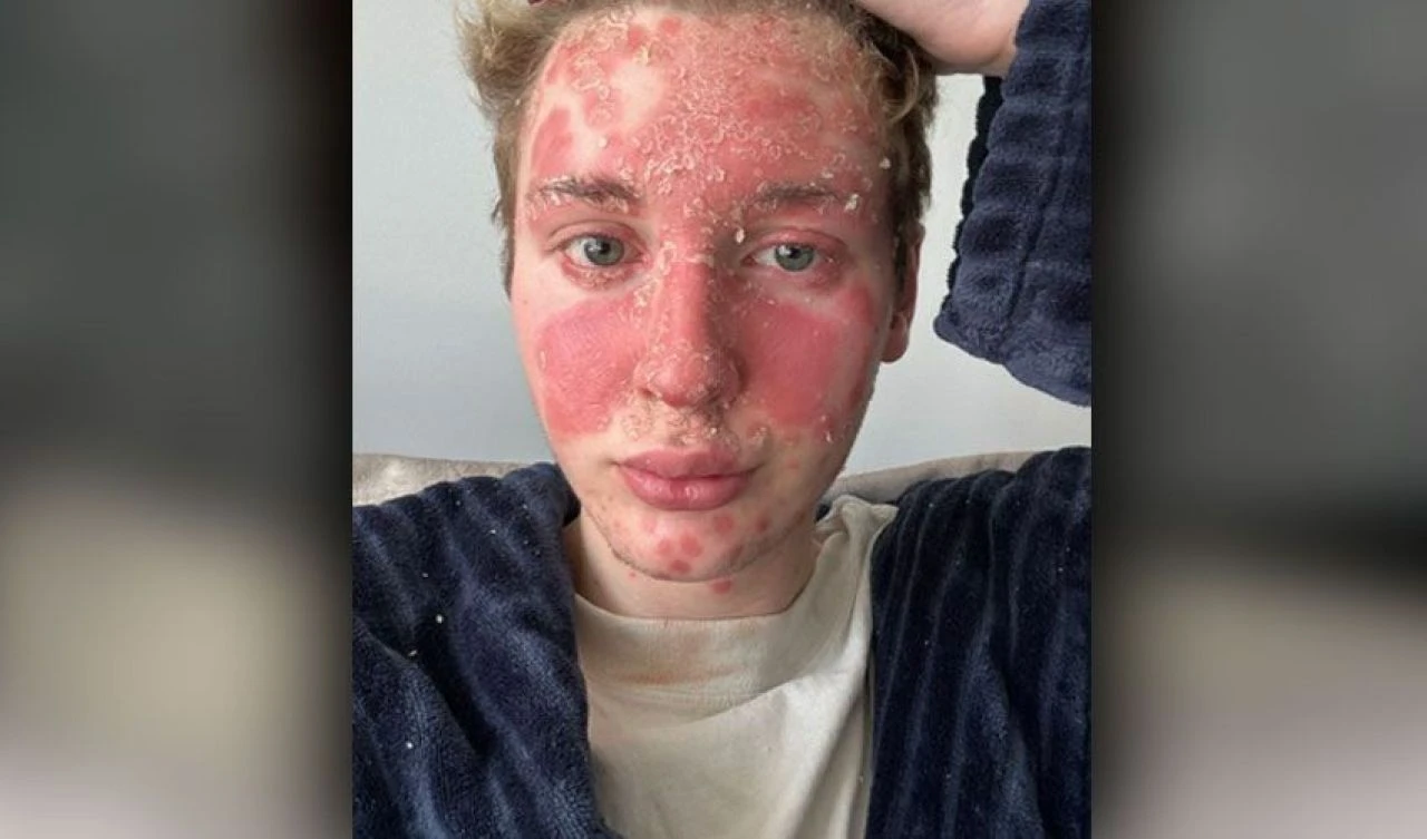 Genç fenomeni dolgu mahvetti! Lekeler önce yüzünü ardından vücudunu kapladı - 1. Resim