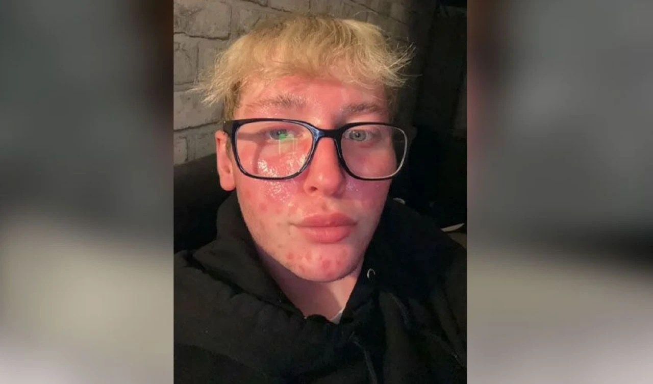 Genç fenomeni dolgu mahvetti! Lekeler önce yüzünü ardından vücudunu kapladı - 5. Resim