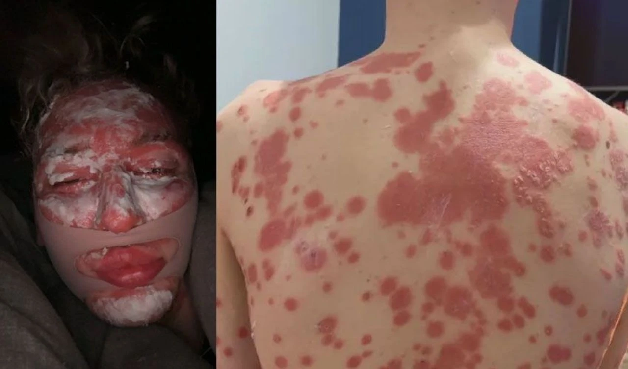 Genç fenomeni dolgu mahvetti! Lekeler önce yüzünü ardından vücudunu kapladı - 3. Resim