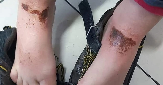 Afyonkarahisar'daki 'gizemli yanıklar'ın nedeni belli oldu