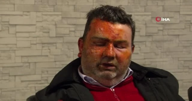 Uyurken dehşeti yaşadı: Kardeşi tarafından yüzü yakıldı