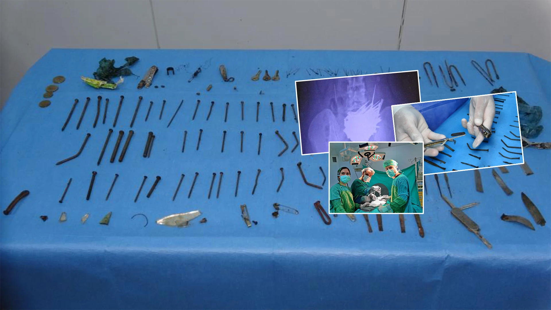 Tırnak makası, bıçak, tığ, cımbız, çengelli iğne, vida… Doktorlar bile dehşete düştü! Midesinden 158 parça metal çıkarıldı