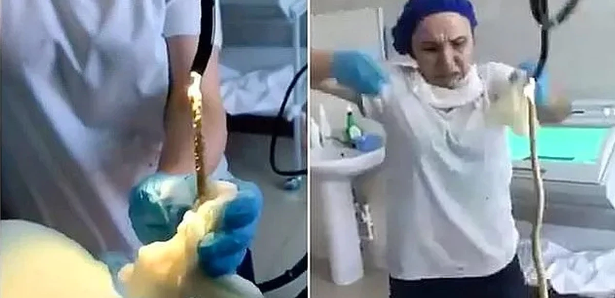 Hastanın midesinden çıkan yılan doktorları bile şaşırttı