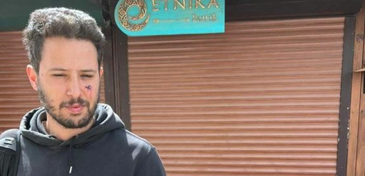 Sevmeye çalıştığı köpek oyuncu Tuan Tunalı’ya saldırdı: Gözünü kaybediyordu