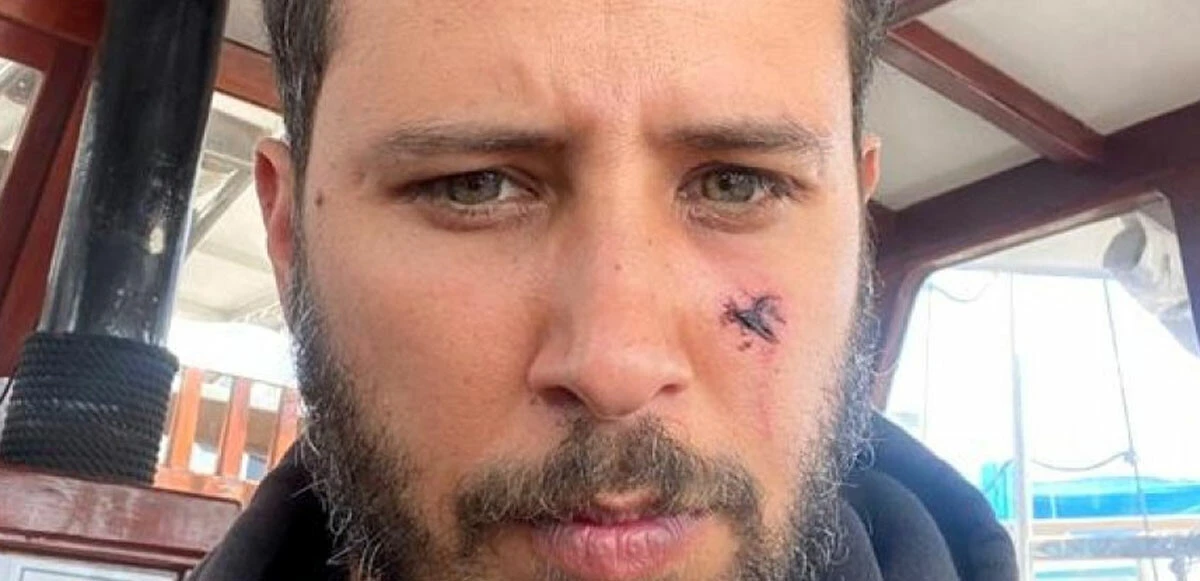 Sevmeye çalıştığı köpek oyuncu Tuan Tunalı’ya saldırdı: Gözünü kaybediyordu