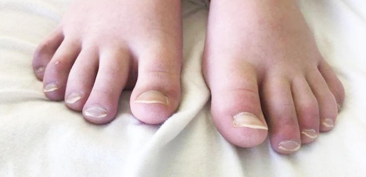 İşte Covid-19'un sıra dışı belirtileri! Aylar sonra bile ortaya çıkabiliyor