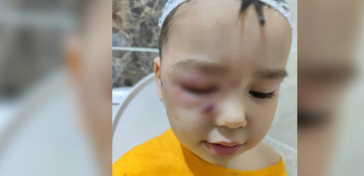 Köpek güzellik yarışmasında dehşet: Ağaca zincirli köpek 3 yaşındaki çocuğun yüzünü parçaladı