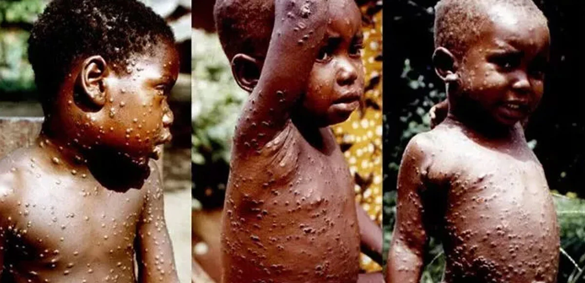 Biri bitmeden diğeri başlıyor! Avrupa'da Maymun çiçeği virüsü paniği: Vakalar artıyor