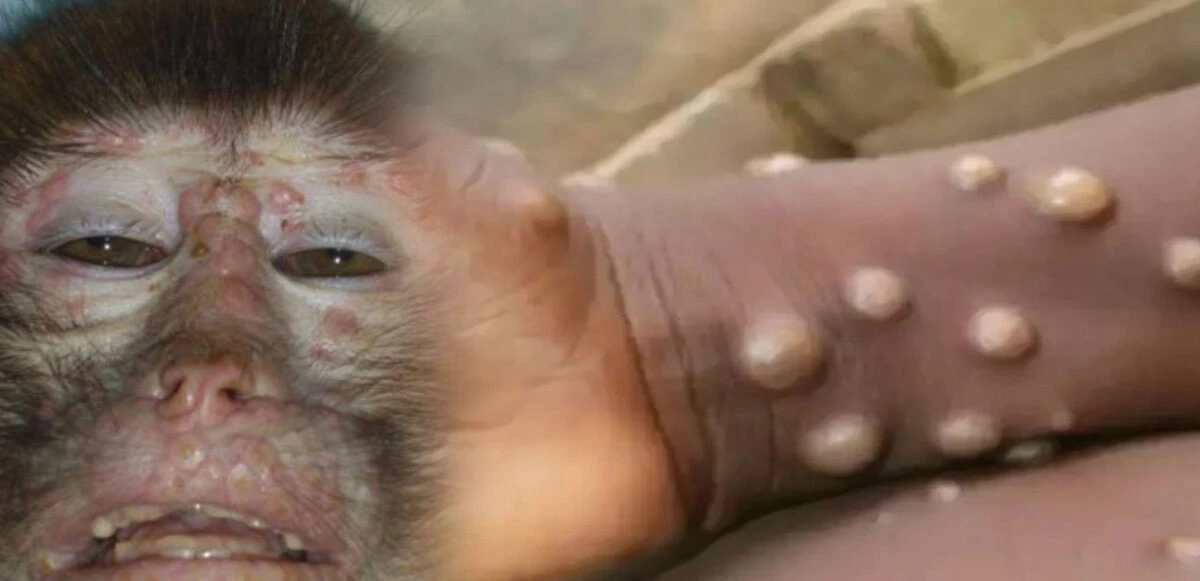 Biri bitmeden diğeri başlıyor! Avrupa'da Maymun çiçeği virüsü paniği: Vakalar artıyor