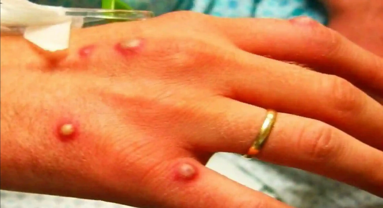 Avrupa'dan ABD ve Kanada'ya da sıçradı: Maymun çiçeği virüsü alarmı