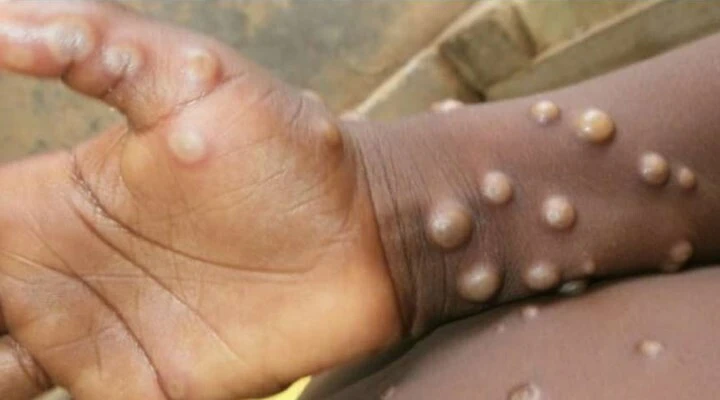 Dünya diken üstünde! Maymun çiçeği virüsü iki ülkede daha görüldü