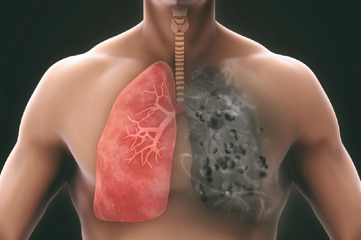 Sigara tiryakileri bağımlısı olacak: 3 günde ciğerleri tertemiz yapan bu kür, vücudu toksinlerden arındırıyor