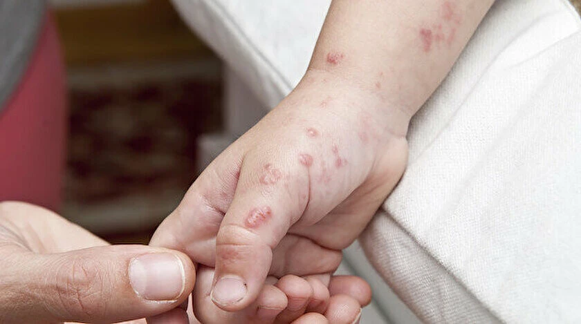 DSÖ'den maymun çiçeği virüsü uyarısı: Birkaç senedir sinsice aramızda dolaşıyor