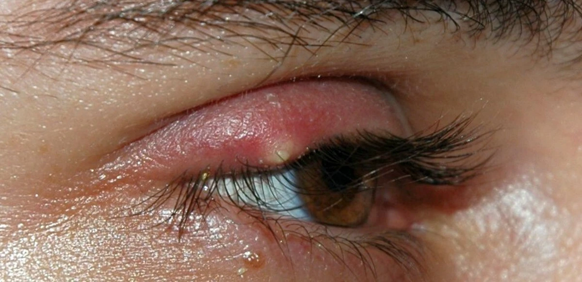 Arpacık kör etmesin! Basit yöntemler ile arpacık kabusuna sonsuza kadar veda edin!