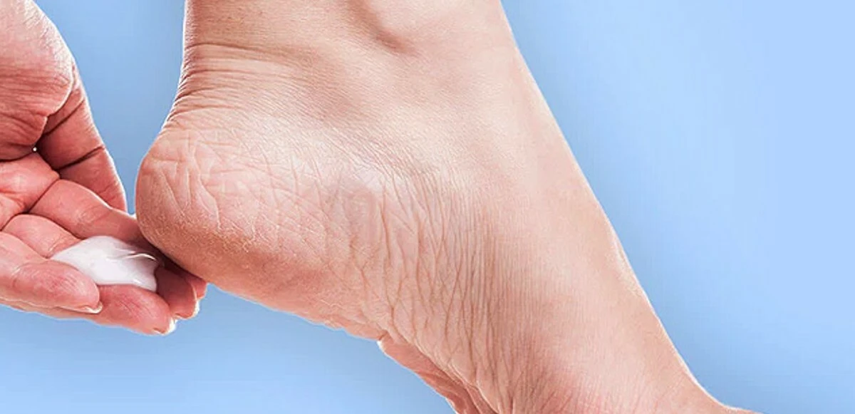 Terlik ve sandaletler sahneye! Yaz boyunca göz önünde olacak ayaklarınızı 'çatlak topuk' görüntüsünden kurtarmanın yolları