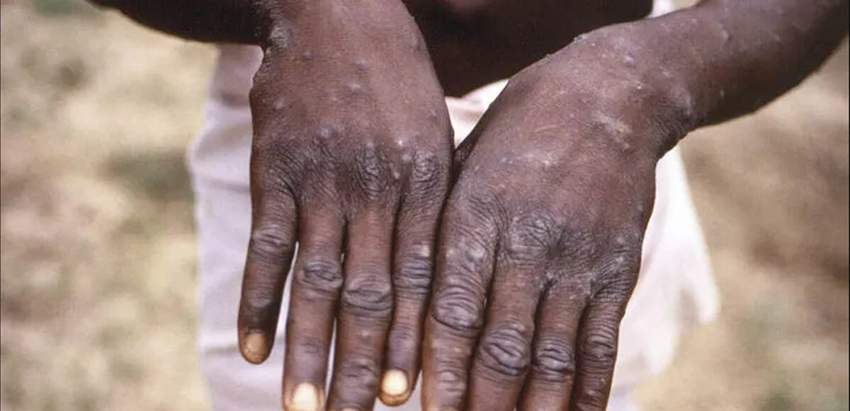 Maymun çiçeği virüsü için ilk yasak! Vaka sayısında artış olacak