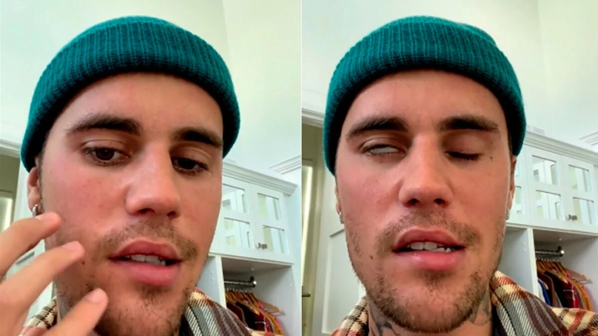 Justin Bieber yüz felci geçirdi! İşte son sağlık durumu