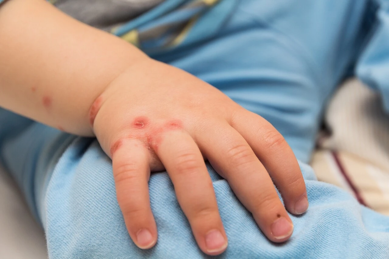 Vakalar artıyor! Maymun çiçeği virüsü bir ülkede daha görüldü