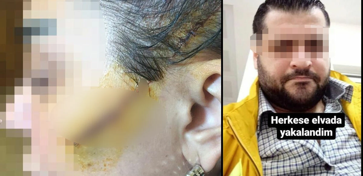 Barışmayı kabul etmeyen eski kız arkadaşının yüzünü kesen sanığa mahkemeden 'emsal' karar