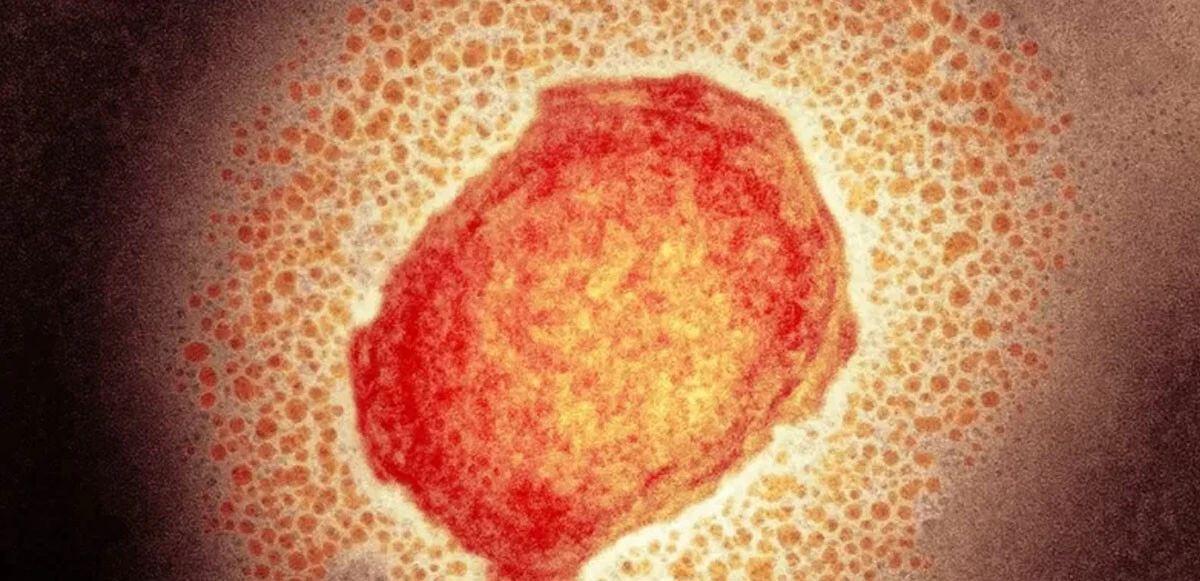 Son dakika: Maymun Çiçeği Türkiye'de görüldü! İstanbul'da görülen ilk vakada 37 yaşındaki hasta tedavi altına alındı