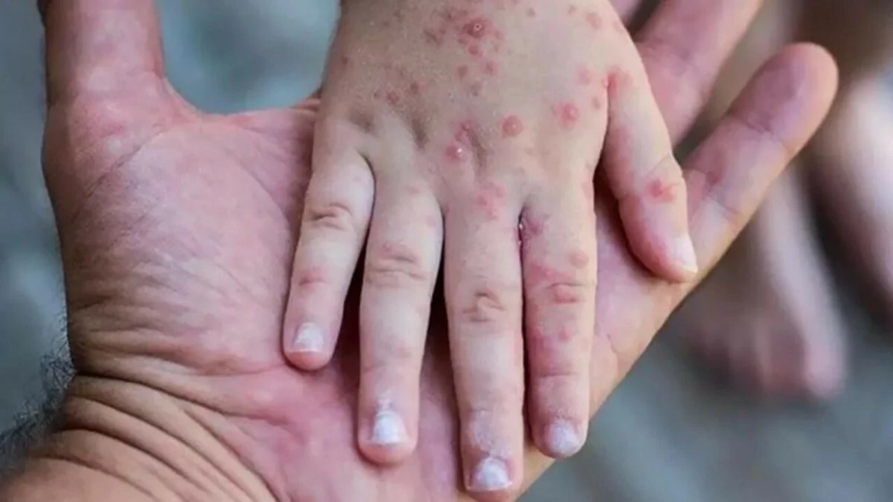 DSÖ açıkladı: Maymun çiçeği virüsü yüzünden 3 kişi öldü