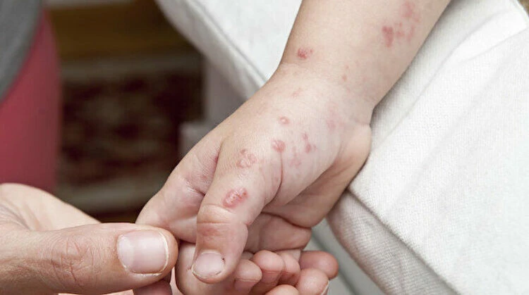 ABD'de maymun çiçeğine karşı aşılama başladı! Yoğun talep siteyi çökertti