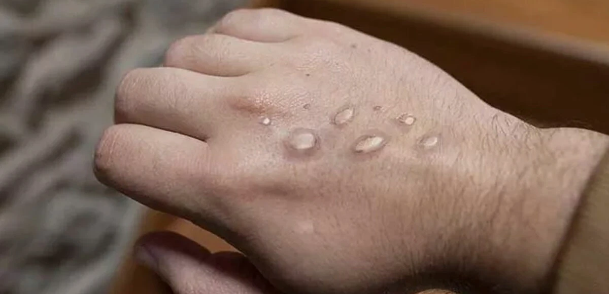 ABD'de maymun çiçeği paniği! İki bölgede acil durum ilan edildi