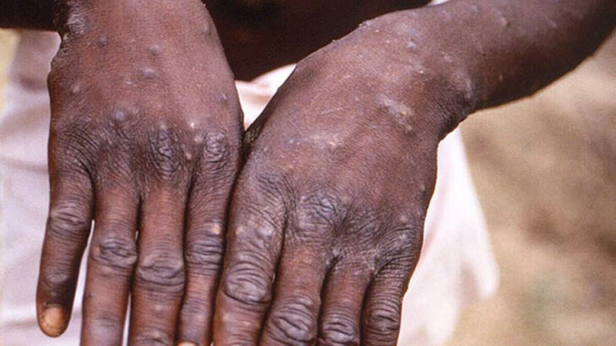 Avrupa'nın ardından Hindistan'da ölüm gerçekleşti! Maymun çiçeği virüsü yayılıyor