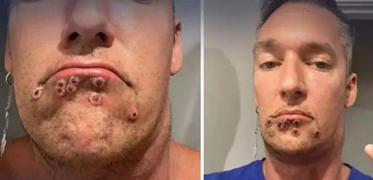 Maymun çiçeğine yakalanan adam yaşadıklarını anlattı, yardım çığlığı yürekleri burktu