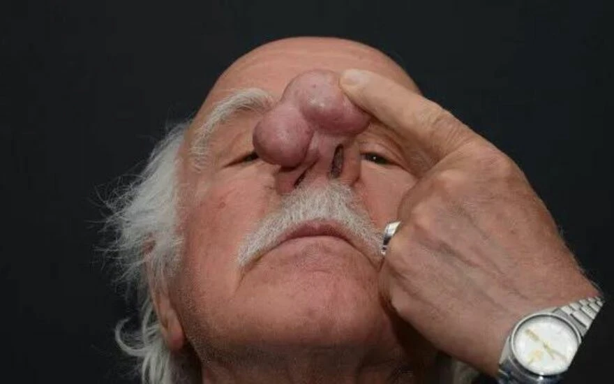 Nefes almakta zorlanan yaşlı adamın burnundan 100 gram kitle alındı! Görenler şok oldu!