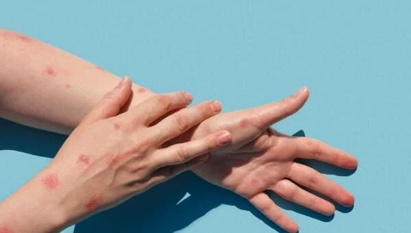 Vakalar arttıkça maymunlar öldürülüyor! Bilim insanlarından maymun çiçeği virüsü çağrısı: Adı değiştirilsin