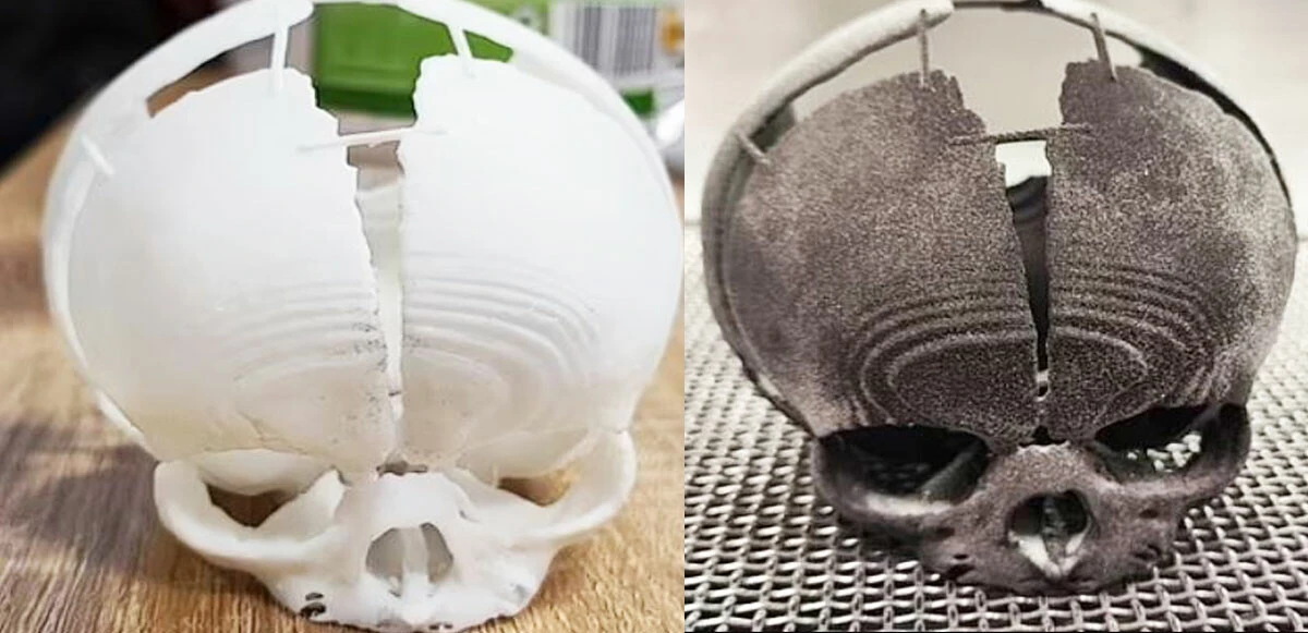 Kafatası eksik doğdu: Yaşamaz dediler, 3 D teknolojisi ile hayata tutundu