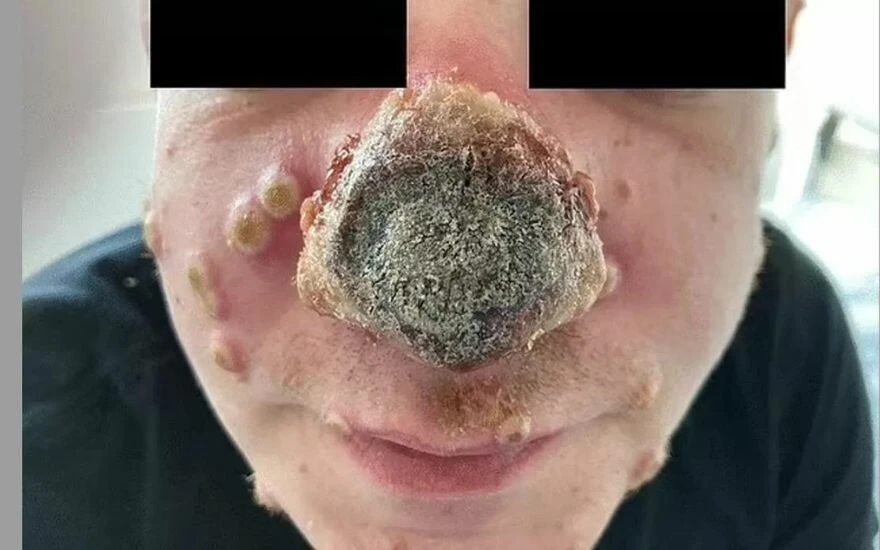 Dönüşüm geçiren maymun çiçeği vakalarına yenisi eklendi! 3 günde burnu çürüdü