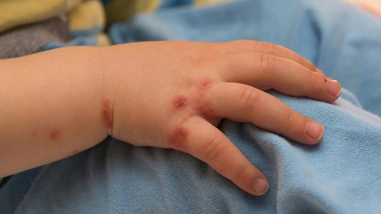 Önce corona ve maymun çiçeği, şimdi de domates gribi çıktı